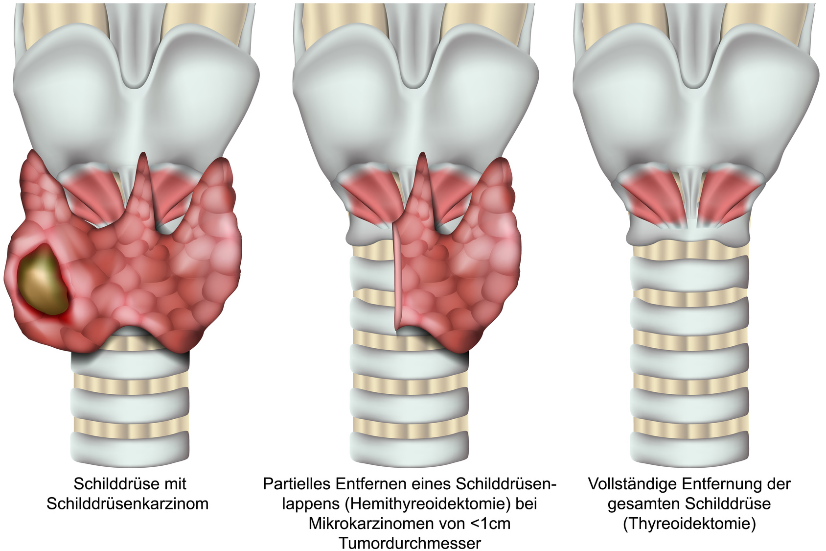 Thyreoidektomie, Entfernung der Schilddrse bei einem Schilddrsenkarzinom, vektor illustration